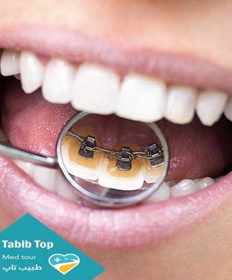 تقويم الأسنان