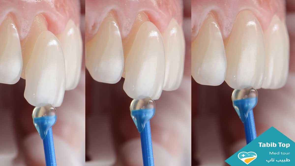 لمینیت دندان