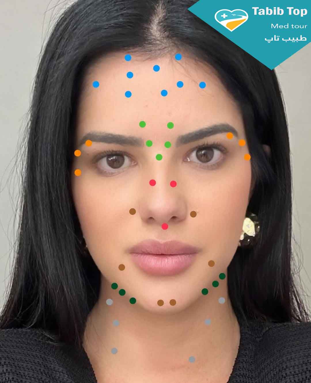 نقاط-تزریق-بوتاکس