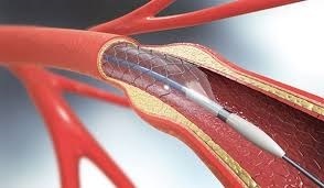 بیش فعالی بزرگسالی