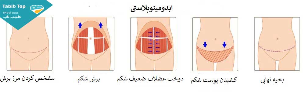 مراحل انجام عمل ابدومینوپلاستی