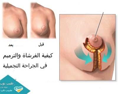 تجمیل الثدی