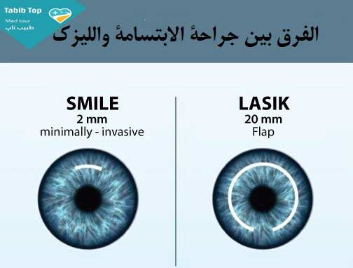 عمليات الليزر للعيون