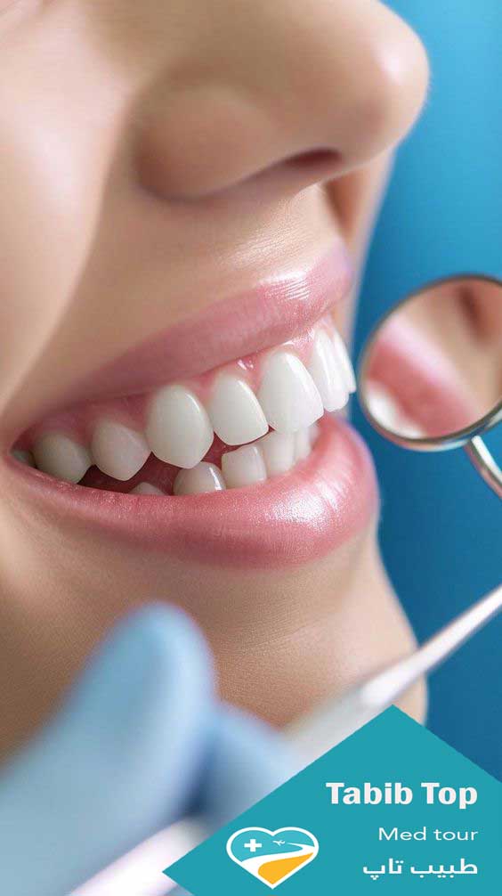 لمینت و کامپوزیت دندان