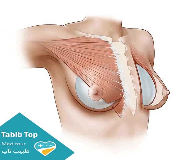 عملية الماموبلاستي 