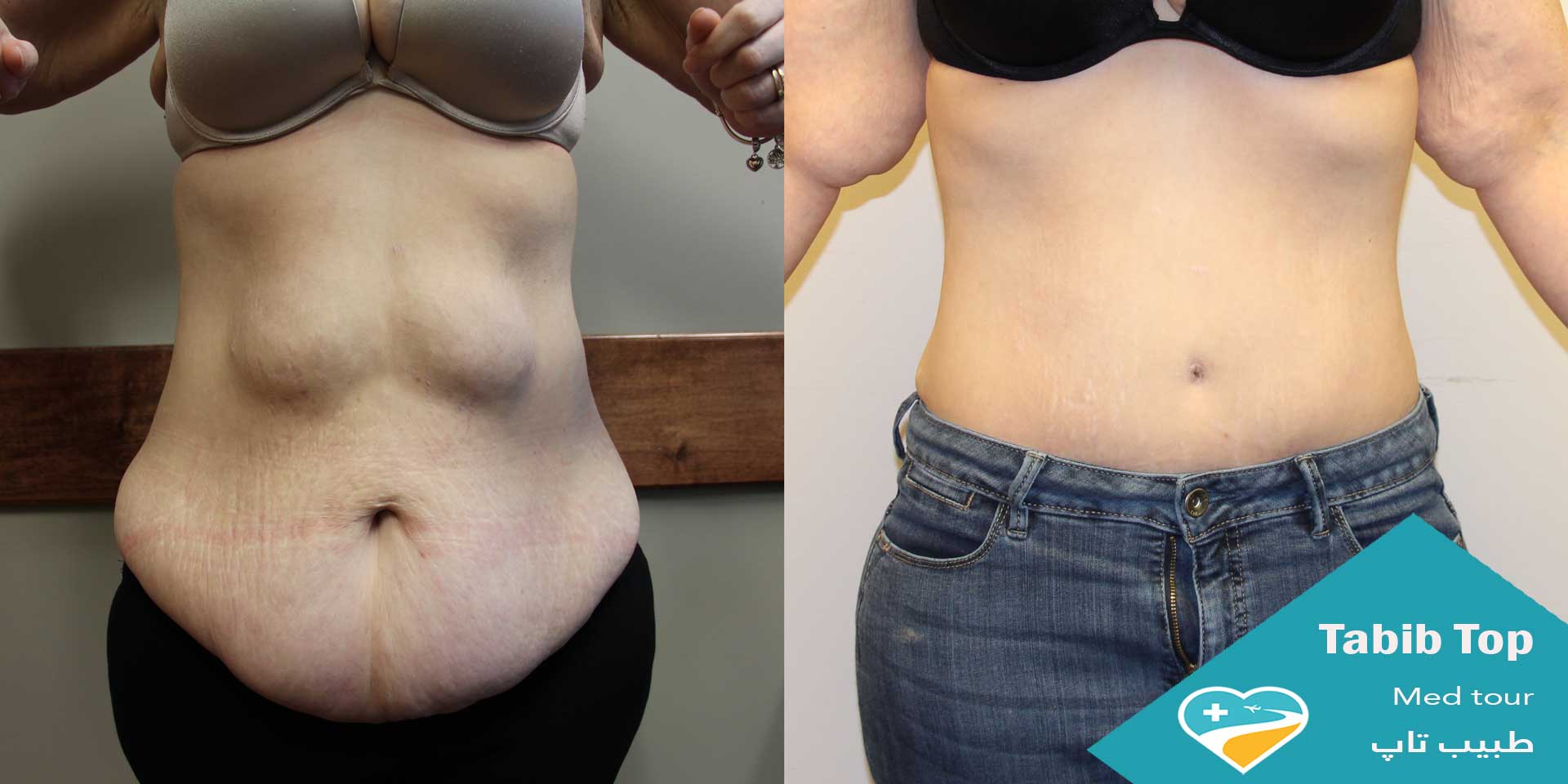 نتیجه ابدومینوپلاستی