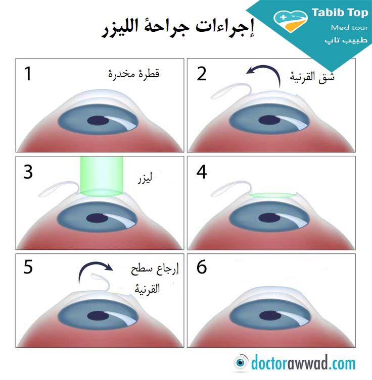 عمليات الليزر للعيون