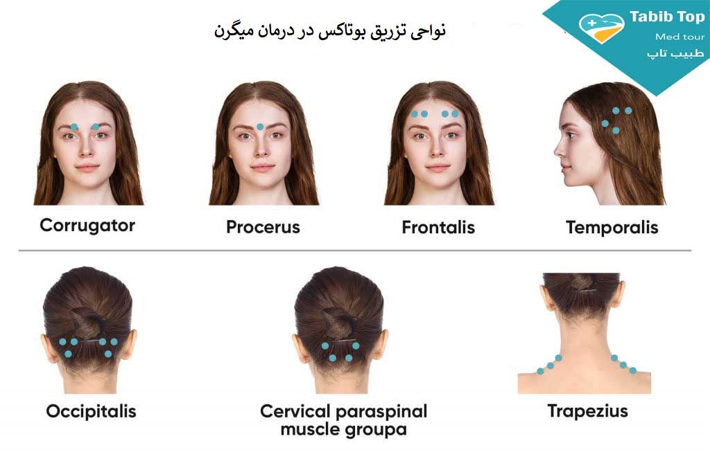 بوتاکس-درمان-میگرن