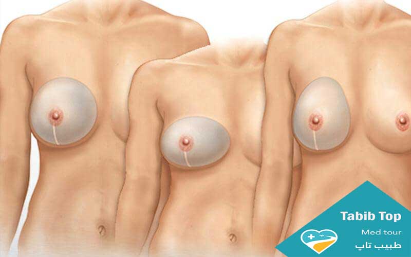 تجمیل الثدی