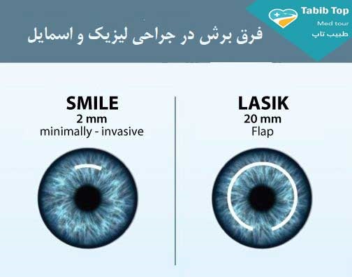 تفاوت عمل لیزیک با اسمایل