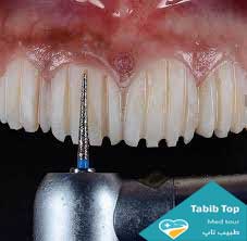 تراش دندان در لمینیت