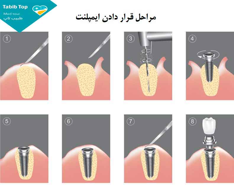 مراحل قراردادن ایمپلنت دندان