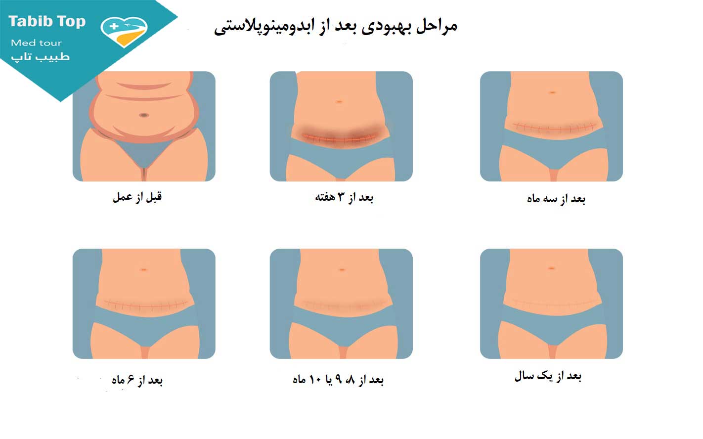 بهبودی بعد از ابدومینوپلاستی