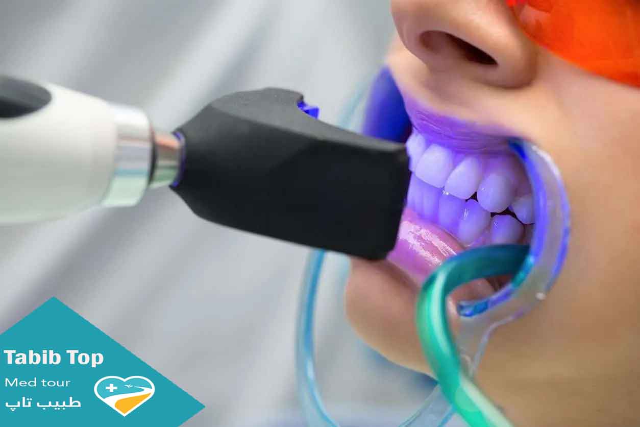 سفید کردن دندان در کلینیک