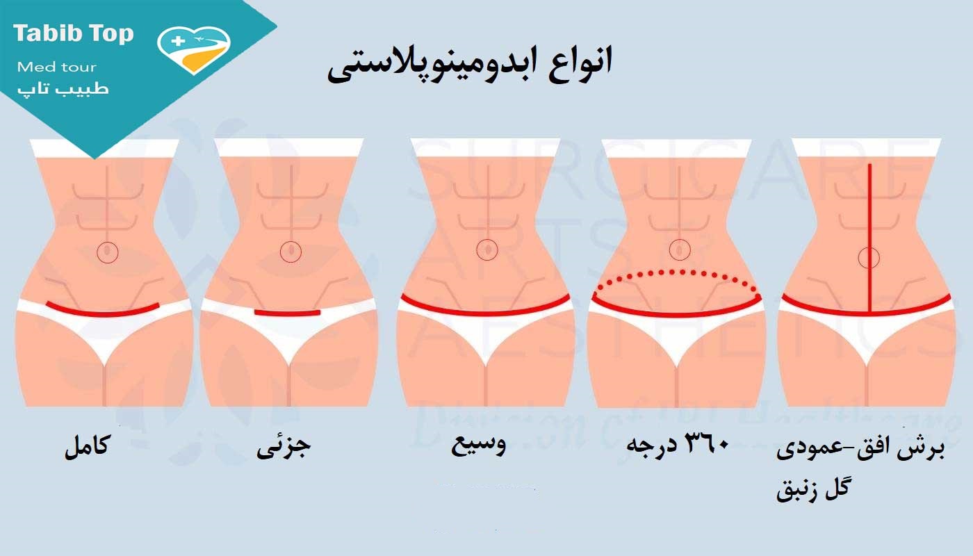 انواع ابدومینوپلاستی