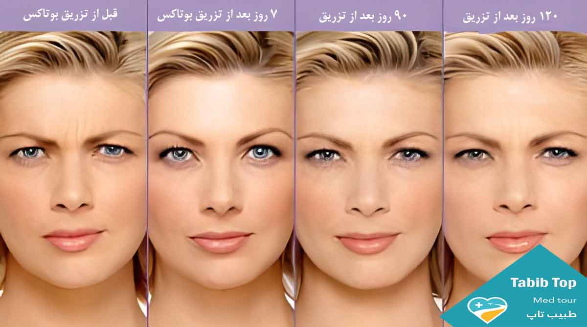 ماندگاری-بوتاکس