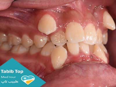 دندان بهم ریخته و نامرتب