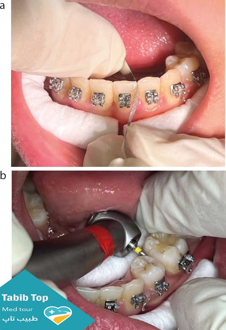 تمیز کردن دندان زمان ارتدونسی