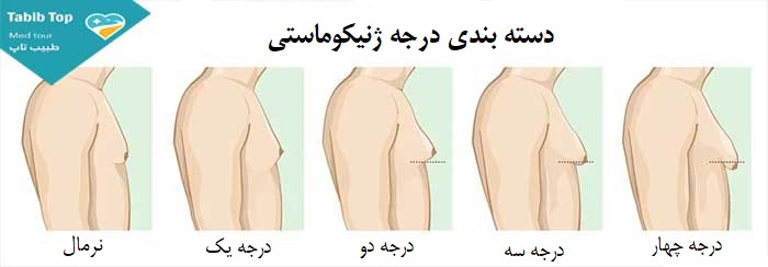 تجمیل الثدی