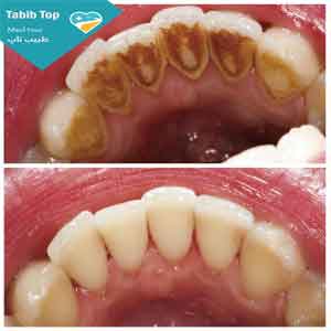 جرم گیری دندان