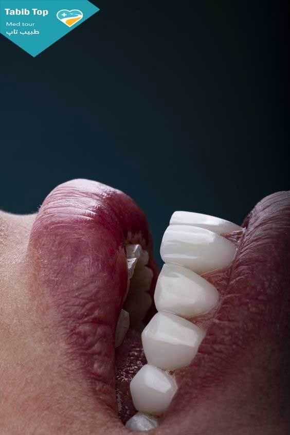 لمینیت یا کامپوزیت؟ مسئله این است