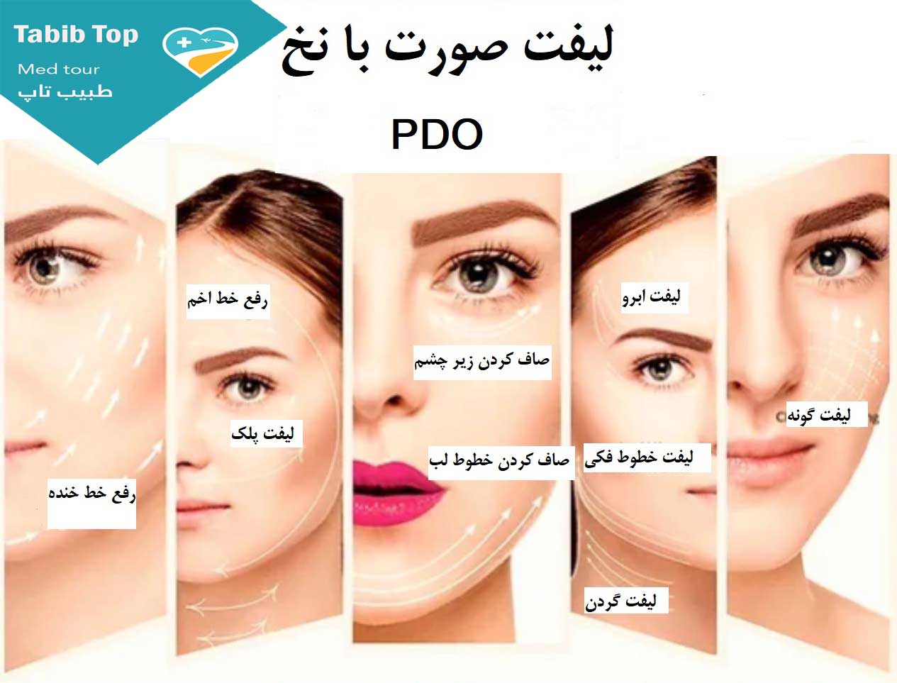 لیفت صورت با نخ