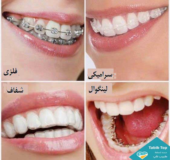 انواع ارتدونسی