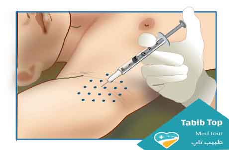 بوتاکس-زیربغل